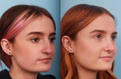 before and after rhinoplasty