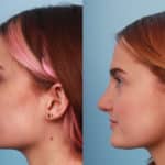 rhinoplasty-merged-8