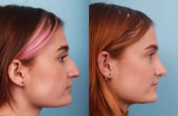 before and after rhinoplasty