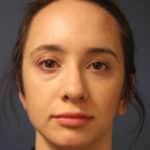 chin-augmentation-after