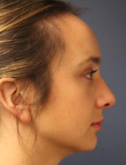 after chin augmentation