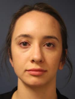after chin augmentation