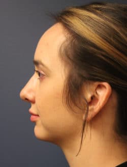 after chin augmentation