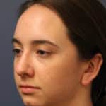chin-augmentation-before-1