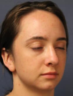 before chin augmentation