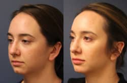 before and after chin augmentation