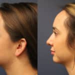 chin-augmentation-merged-3