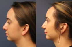 before and after chin augmentation