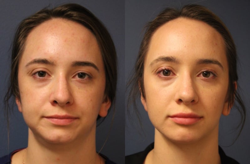 before_after_img