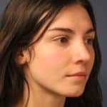 rhinoplasty-after-2
