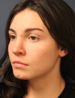 after rhinoplasty
