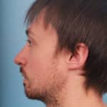 rhinoplasty-after-7