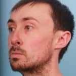 rhinoplasty-before-1