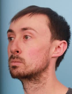 before rhinoplasty
