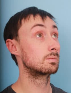 before rhinoplasty