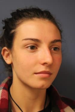 before rhinoplasty