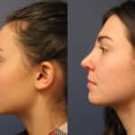 rhinoplasty-merged-1