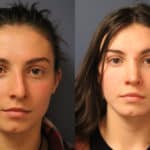 rhinoplasty-merged