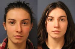 before and after rhinoplasty