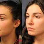 rhinoplasty-merged-3