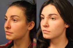before and after rhinoplasty