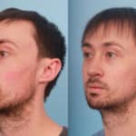 rhinoplasty-merged-4