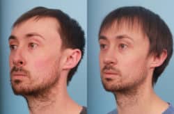 before and after rhinoplasty