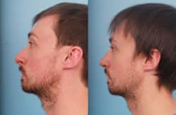 before and after rhinoplasty