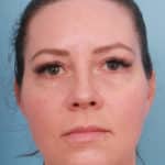 lower-facelift-after