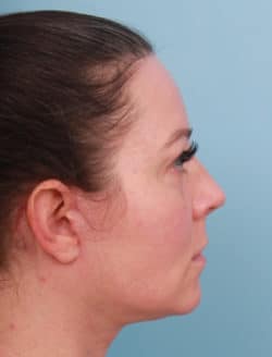 after lower facelift