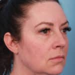 lower-facelift-before-1