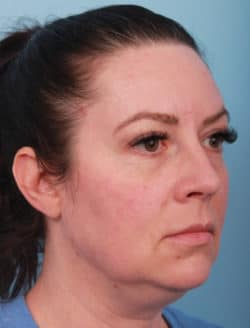 before lower facelift