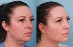 before and after lower facelift