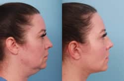before and after lower facelift