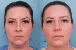 before and after lower facelift