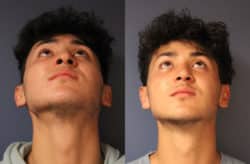 before and after rhinoplasty
