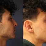 rhinoplasty-merged-5