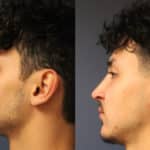 rhinoplasty-merged-6