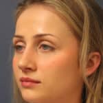 rhinoplasty-after-4