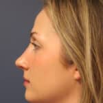 rhinoplasty-after-5