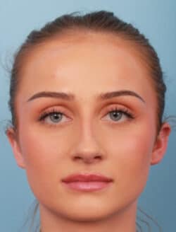 before rhinoplasty