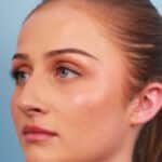 rhinoplasty-before-4
