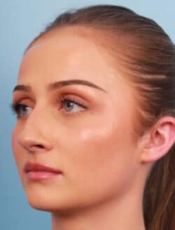 before rhinoplasty