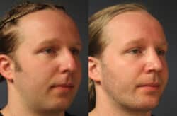 before and after rhinoplasty