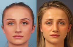 before and after rhinoplasty