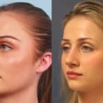 rhinoplasty-merged-4
