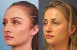 before and after rhinoplasty
