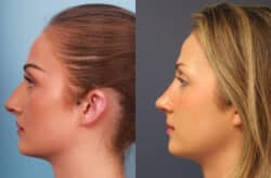 before and after rhinoplasty