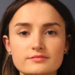 rhinoplasty-after