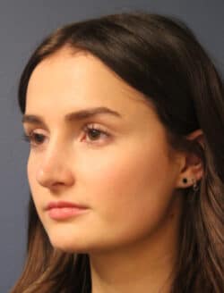 after rhinoplasty